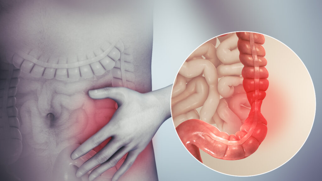 Dieta para Síndrome do Intestino Irritável