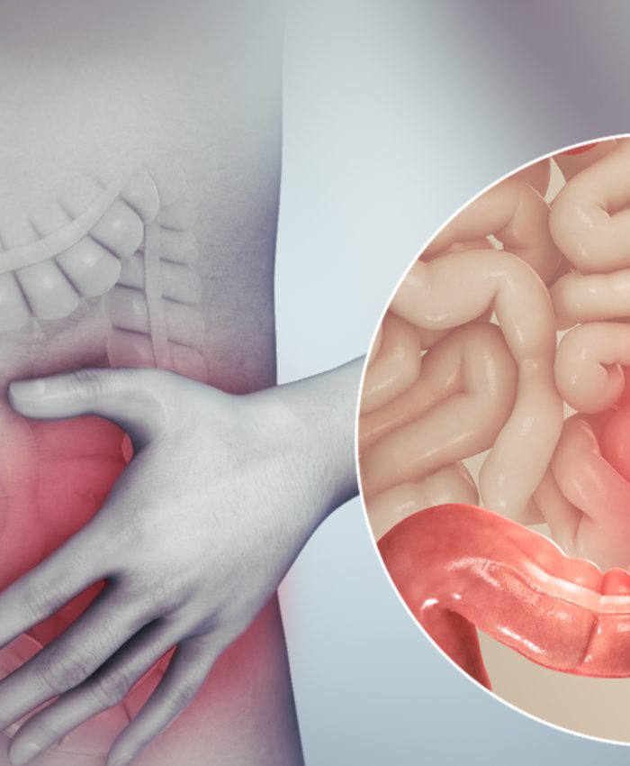 5 Mudanças no estilo de vida para ajudar na Síndrome do Intestino Irritável (SII)