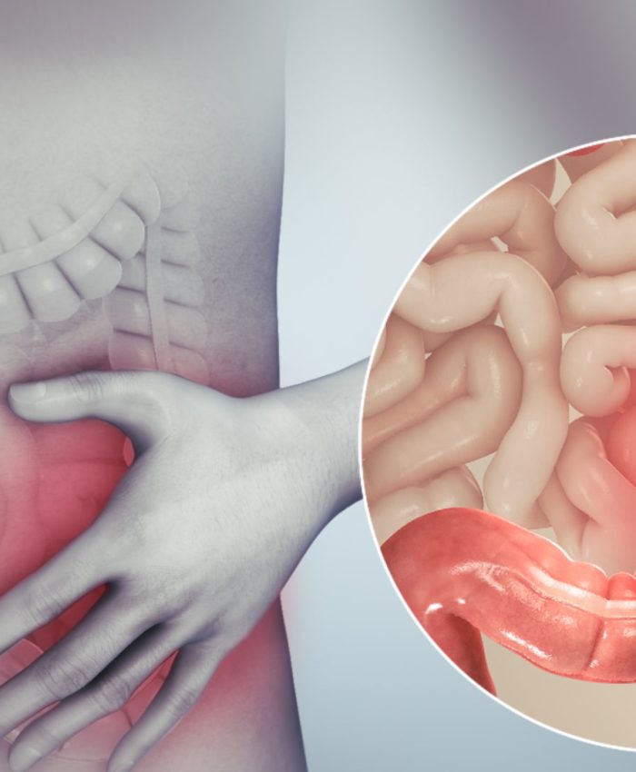 Síndrome do Intestino Irritável: o que fazer quando estiver com SII?